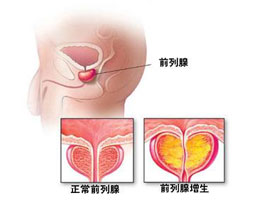 膀胱炎