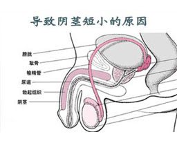 前列腺钙化